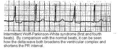 WOLFF-PARKINSON-WHITE SYNDROME