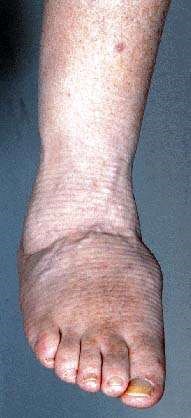 CHARCOT JOINT