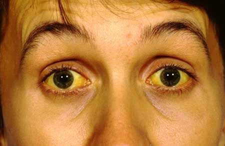 who to go to with symptoms of jaundice and scleral icterus