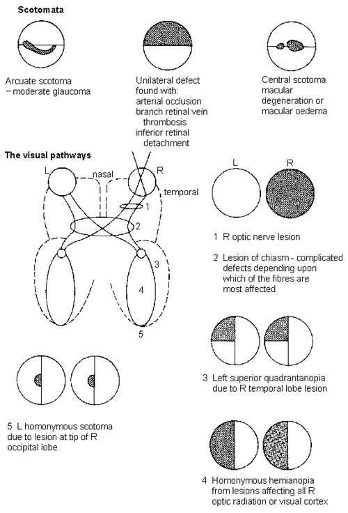 Visual Field Defects. Free Medical Information | Patient