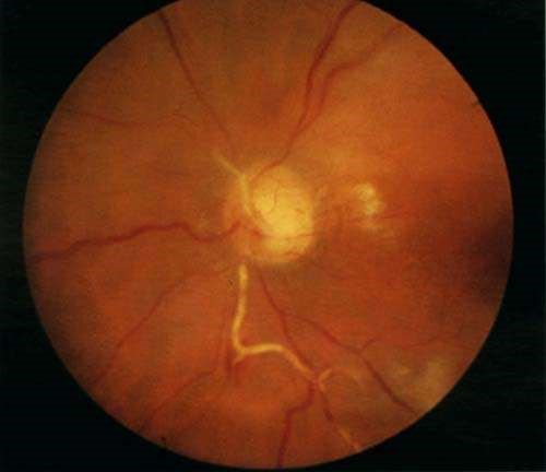 CENTRAL RETINAL ARTERY OCCLUSION