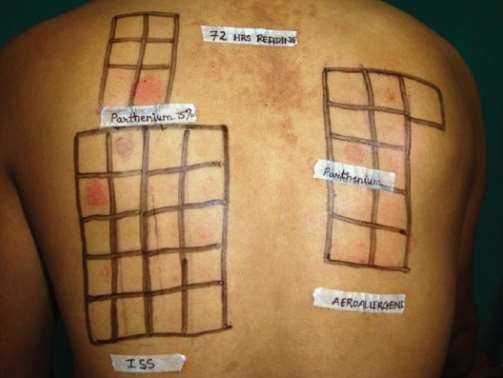 patch-testing-for-contact-dermatitis-health-patient