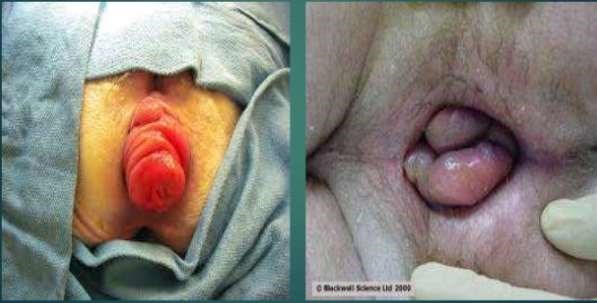 Rectal Prolapse and Haemorrhoid