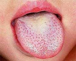 Scarlet fever on tongue