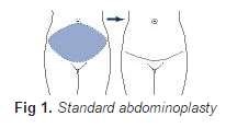Standard abdominoplasty