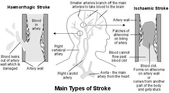Cross-section diagram showing main arteries of the brain and the main types of stroke