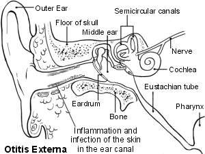 The ear - otitis externa