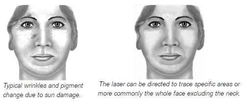 Wrinkles and laser surgery