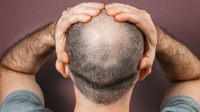 Can vitamins really prevent hair loss?