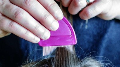How to check your child for head lice and nits