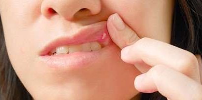 What causes mouth ulcers and how to treat them