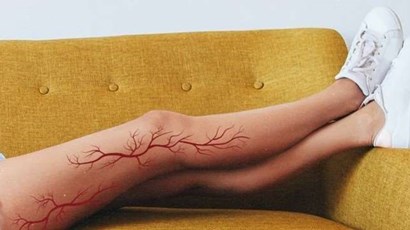 How to prevent varicose veins
