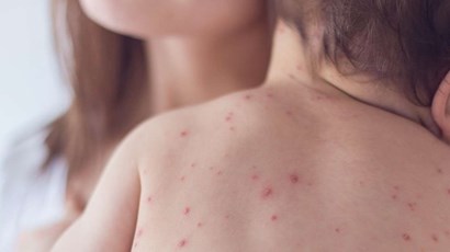 What is the difference between hand, foot and mouth disease and chickenpox?