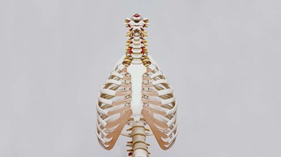 What causes costochondritis?