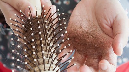 Understanding female hair loss