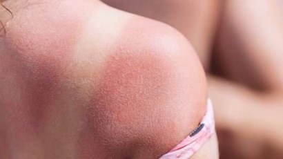How to treat sunburn blisters