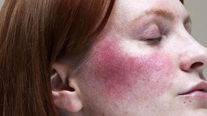 Rosacea treatments: which is right for you? 