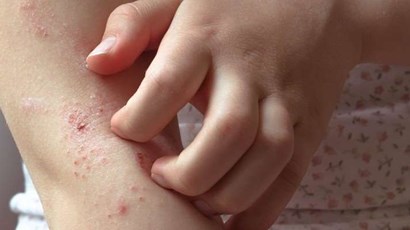 Why eczema itches - and how to stop it